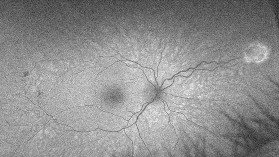 Figure 3. Hémangioblastomes rétiniens multiples dans le cadre d’un syndrome de von Hippel-Lindau (cliché en autofluorescence).
