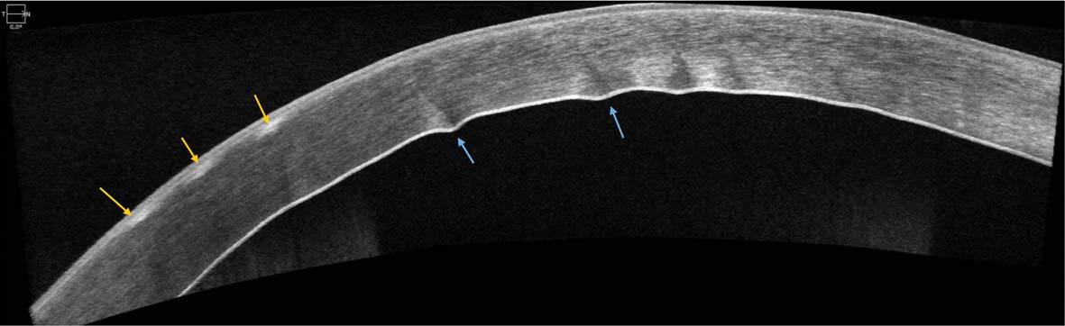 Figure 2. Image OCT de la cornée : hyperréflectivité des poils intracornéens (flèches jaunes), plis descemétiques (flèches bleues).
