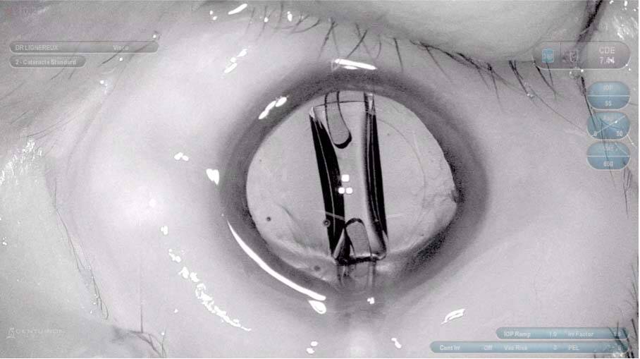 Figure 3. Utilisation d’un filtre noir et blanc durant la chirurgie de la cataracte.
