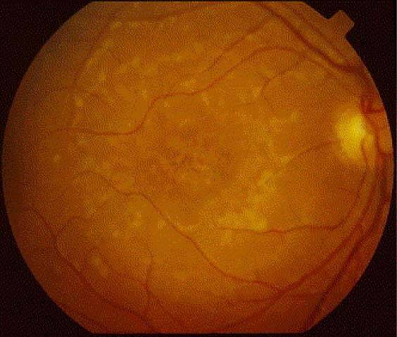 Figure 3. Maladie de Stargardt (© Dr Besch).
