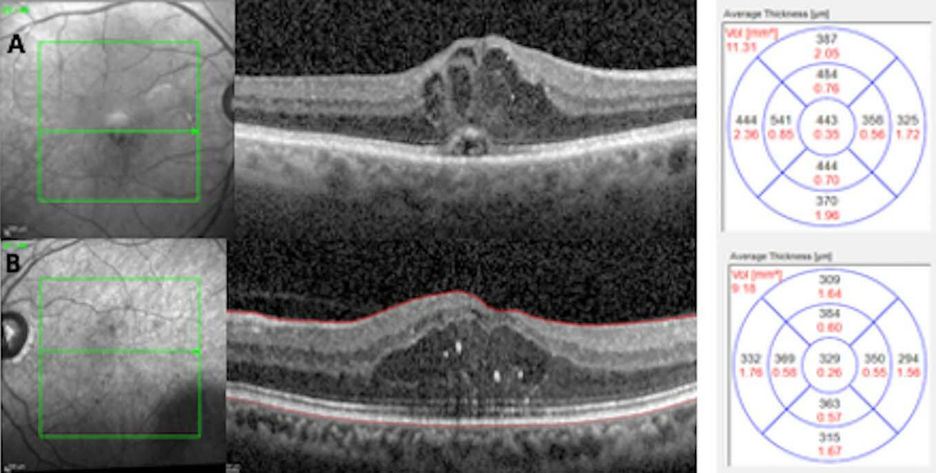 Figure 2. OMD sévère bilatéral avec épaississement rétinien central et acuité visuelle à 5/10 œil droit (A) et 8/10 œil gauche. Un traitement intravitréen par anti-VEGF est débuté chez ce patient uniquement sur l’œil droit, mais avec une surveillance systématique de l’OMD de l’œil gauche tous les 2 à 3 mois maximum (acuité visuelle et OCT).
