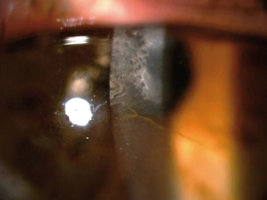 Figure 1. Examen à la lampe à fente préopératoire de l’œil gauche.
