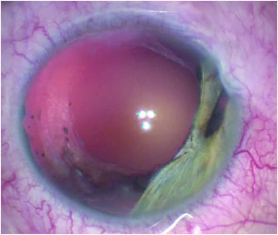 Figure 1. Aspect préopératoire, reliquat irien et aphake avec cornée claire.
