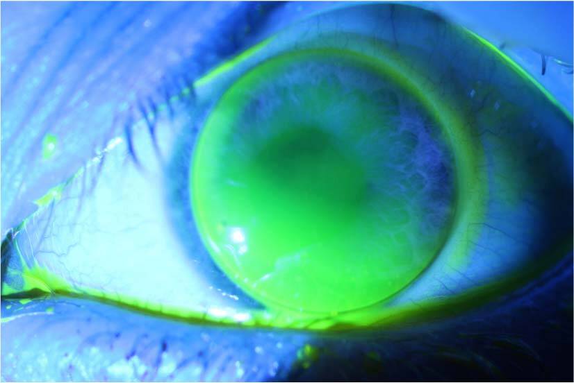 Figure 2. Lentille rigide torique Menicon ZBTC bien mobile ; coloration homogène de fluorescéine montrant l’absence de zones d’appui.
