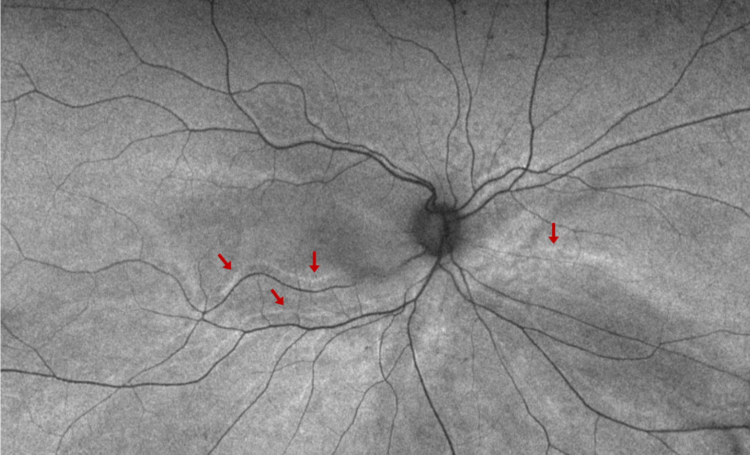 Figure 1. Déplacement rétinien chez un patient opéré d’un décollement de rétine par vitrectomie et tamponnement par gaz. Imagerie en autofluorescence ultra grand champ montrant des lignes hyper-autofluorescentes correspondant à l’empreinte des vaisseaux rétiniens avant réapplication (flèches rouges)

