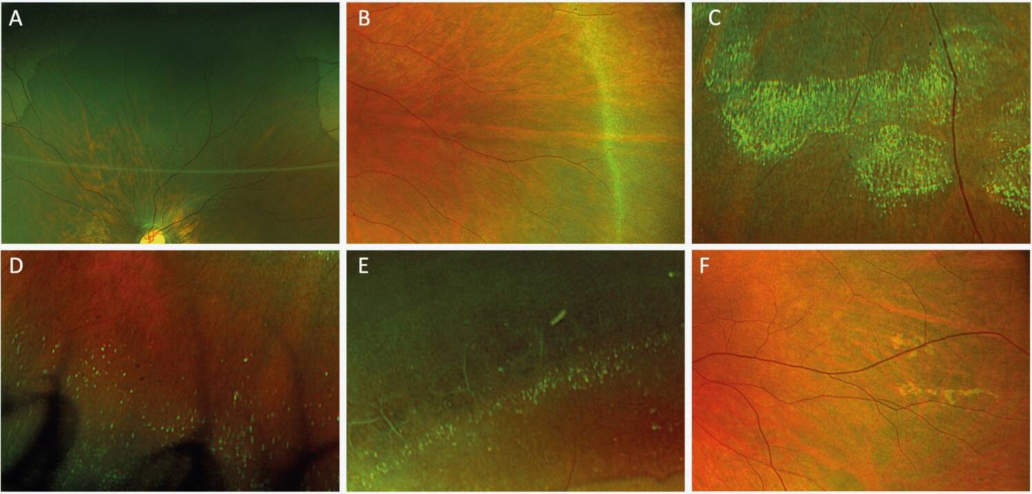 Figure 1. Exemples représentatifs des principales lésions rétiniennes périphériques chez l’enfant myope fort en imagerie ultra-grand champ.
A. Noir sans pression (NSP/DWP) : plage hyperpigmentée à contours géographiques, de distribution diffuse.
B. Blanc sans pression (BSP/WWP) : plage blanchâtre translucide, de topographie temporale.
C. Dégénérescence en bave d’escargot (Snail-Track) ; bande allongée brillante, amincissement rétinien localisé.
D. Dégénérescences microkystiques (cystoid degeneration) : petites cavités intrarétiniennes périphériques. 
E. Dégénérescence palissadique (Lattice) : plage d’amincissement rétinien avec pigmentations irrégulières.
F. Anomalie périphérique non classifiable : aspect atypique ne correspondant pas aux catégories nosologiques habituelles, catégorie prédominante chez les enfants de 4 à 6 ans après le NSP.
