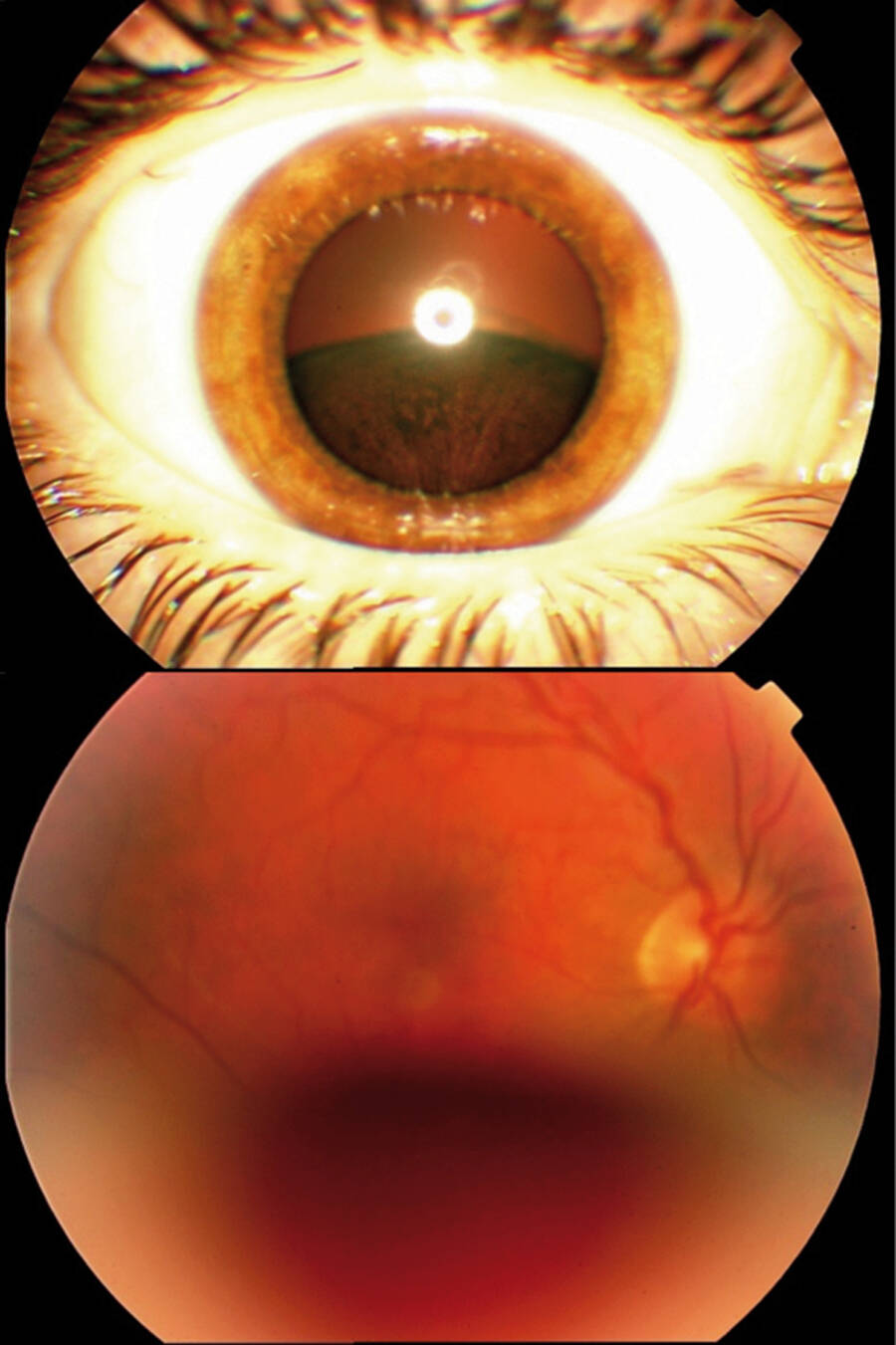 Figure 4. En haut : Tumeur pigmentée inférieure visible en examen lampe à fente. En bas : Lésion très antérieure et inférieure gênant l’examen du fond d’œil (photo : Dr Matet, Institut Curie).
