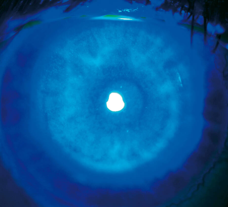 Figure 3. Examen biomicroscopique de l’œil droit sans la lentille sclérale, après l’instillation de fluorescéine en lumière bleue.
