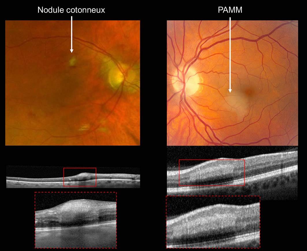 Figure 1. Comparaison de l’imagerie d’un nodule cotonneux et d’une lésion de PAMM. Les 2 lésions présentent un aspect blanchâtre mais en OCT, le nodule cotonneux se traduit par une hyperréflectivité des couches internes de la rétine, alors que la PAMM se traduit par une hyperréflectivité plus profonde, au niveau de la couche nucléaire interne.
