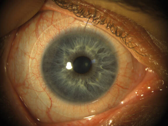 Figure 1. Examen biomicroscopique en lumière blanche de l’œil droit avec la lentille sclérale.
