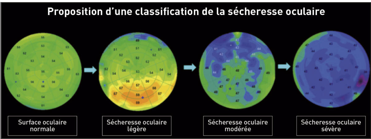 Figure 4. Proposition de classification de la sécheresse oculaire à partir des cartographies épithéliales selon différents stades.
