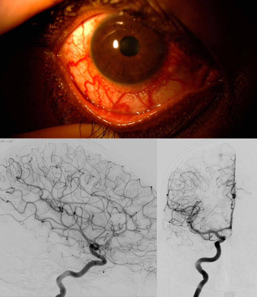 Figure 2. Hypertonie et glaucome unilatéral de l’œil droit chez un patient de 30 ans connu depuis 5 ans. L’examen retrouve une dilatation des vaisseaux épiscléraux, évocatrice d’un obstacle posttrabéculaire. L’IRM a permis d’éliminer une tumeur gênant le drainage veineux et n’a pas retrouvé de fistule. Une angiographie cérébrale a dû être réalisée pour confirmer l’absence de fistule durale, dont le traitement aurait permis de mieux contrôler le glaucome. Certaines fistules durales peuvent se boucher spontanément et laisser de manière séquellaire une dilatation des vaisseaux épiscléraux et un glaucome qui s’est autonomisé. 
