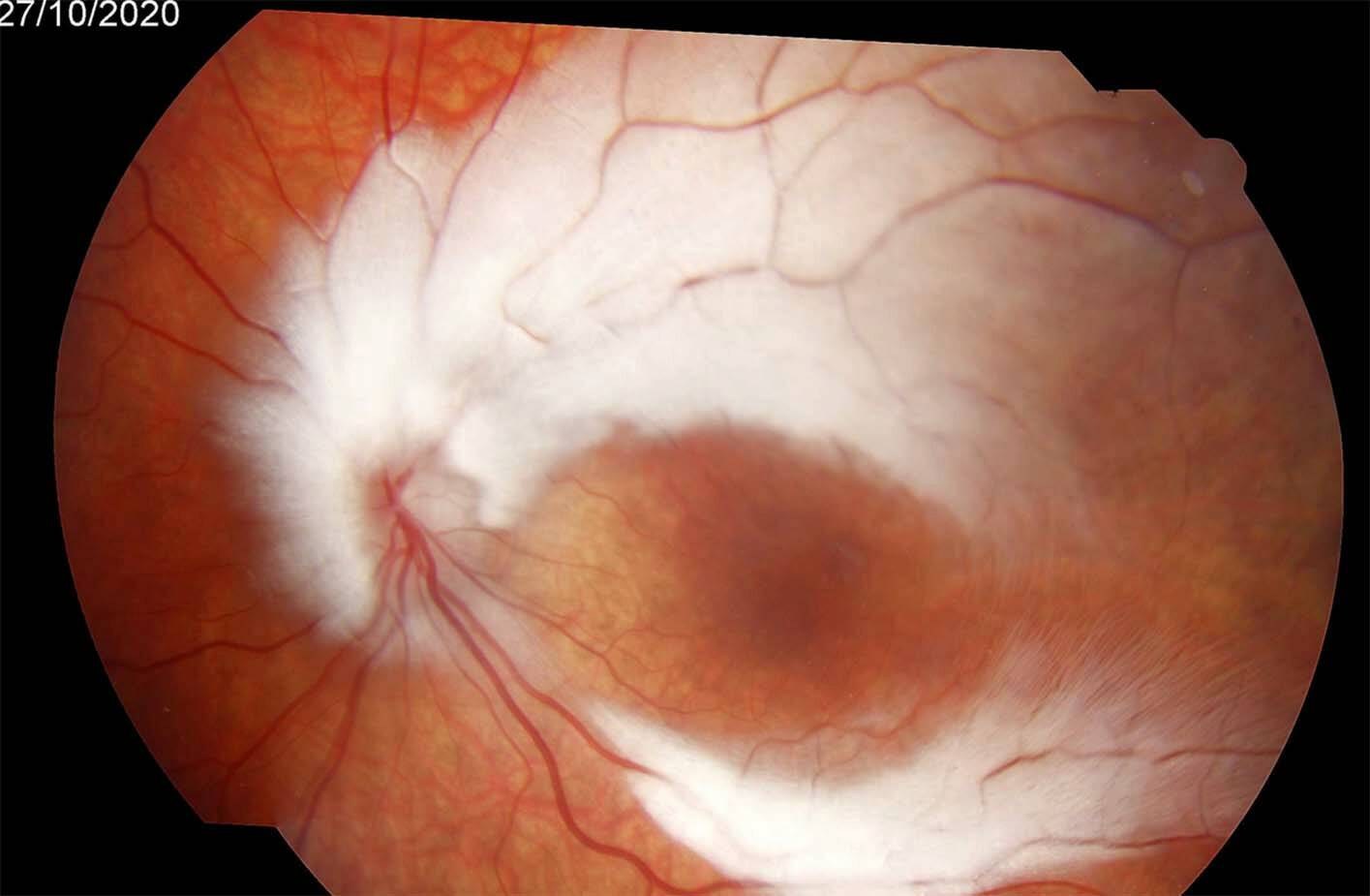 Figure 1. Fond d’œil (OG). Fibres rétiniennes myélinisées étendues en supérotemporal et inférotemporal.
