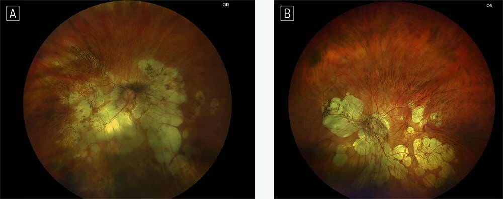 Figures 2A et 2B. Rétinophotos d’un patient myope fort - 16,00 OD (A) et - 17,50 OG (B) présentant un glaucome traité par trithérapie. Noter la présence d’une atrophie choriorétinienne diffuse, de staphylomes péripapillaires et maculaires des 2 côtés, ainsi qu’une dysversion papillaire plus marquée à gauche.
