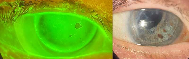 Figure 3. Examen à la lampe à fente de l’adaptation en piggy back avec LRPG Menicon Rose K2 PG et LSH Alcon Dailies Total One. À gauche : Examen à la fluorescéine satisfaisant, présence de bulles de pose ; il conviendra de revoir la manipulation pour les éviter. À gauche : Examen en lumière blanche, LRPG décentrée vers le haut.
