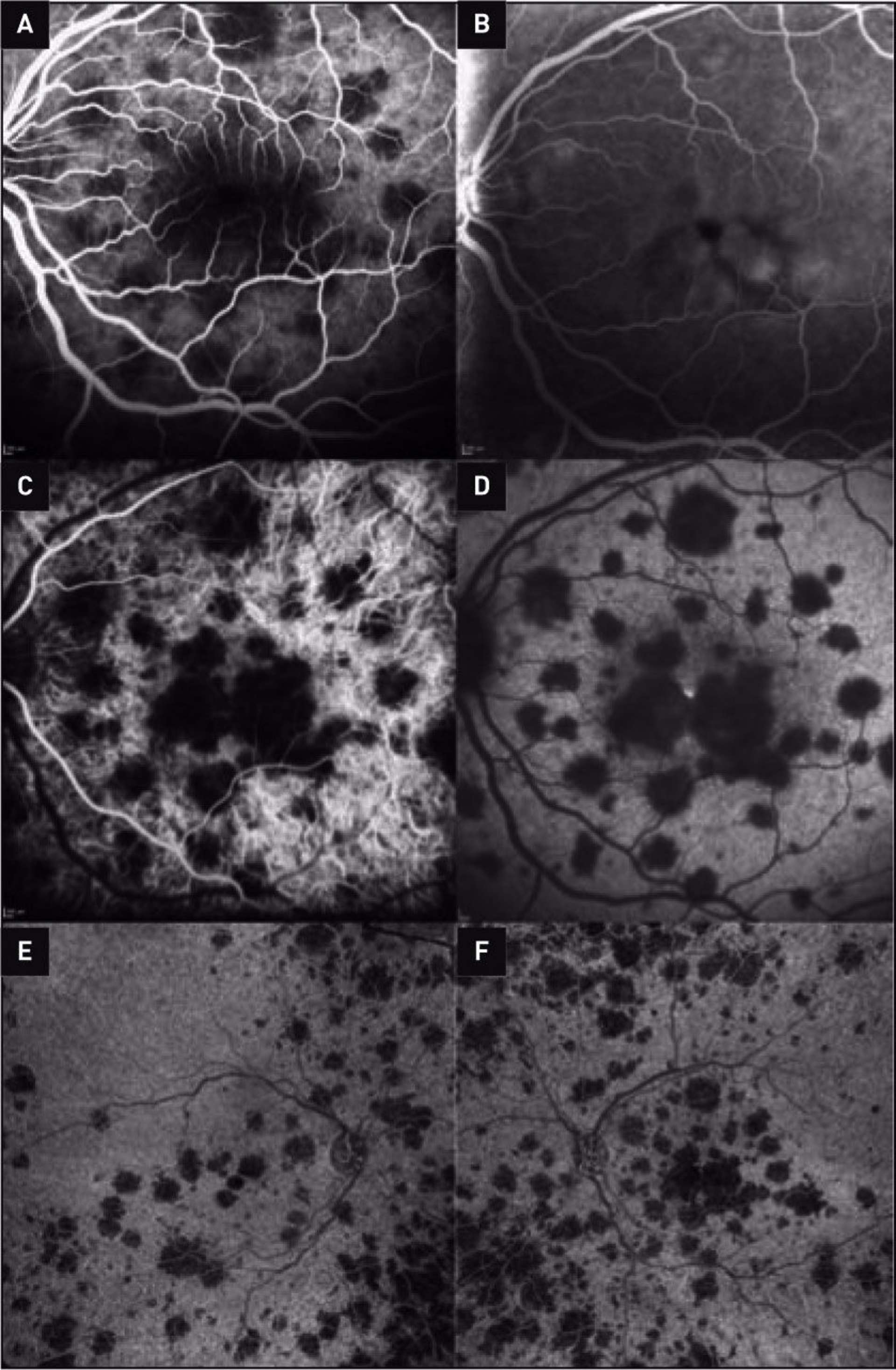 Figure 2. A. Angiographie à la fluorescéine temps précoce : les lésions sont hypofluorescentes. B. Angiographie à la fluorescéine temps tardif : les lésions apparaissent isofluorescentes ; à noter l’hyperfluorescence par remplissage de la zone œdémateuse maculaire. C. Angiographie au vert d’indocyanine au temps précoce révélant des lésions hypofluorescentes ICG. D. Angiographie au vert d’indocyanine temps tardif : les lésions apparaissent toujours hypofluorescentes ICG. E et F. Clichés OCT-A de l’œil droit et de l’œil gauche objectivant des zones de diminution du flux choriocapillaire correspondant aux zones hypofluorescentes sur le cliché central d’ICG.
