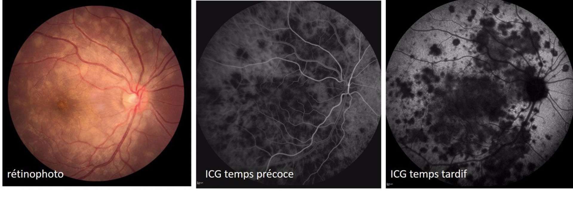 Figure 2. Épithéliopathie en plaques. En ICG notons une hypofluorescence des temps précoces aux temps tardifs.
