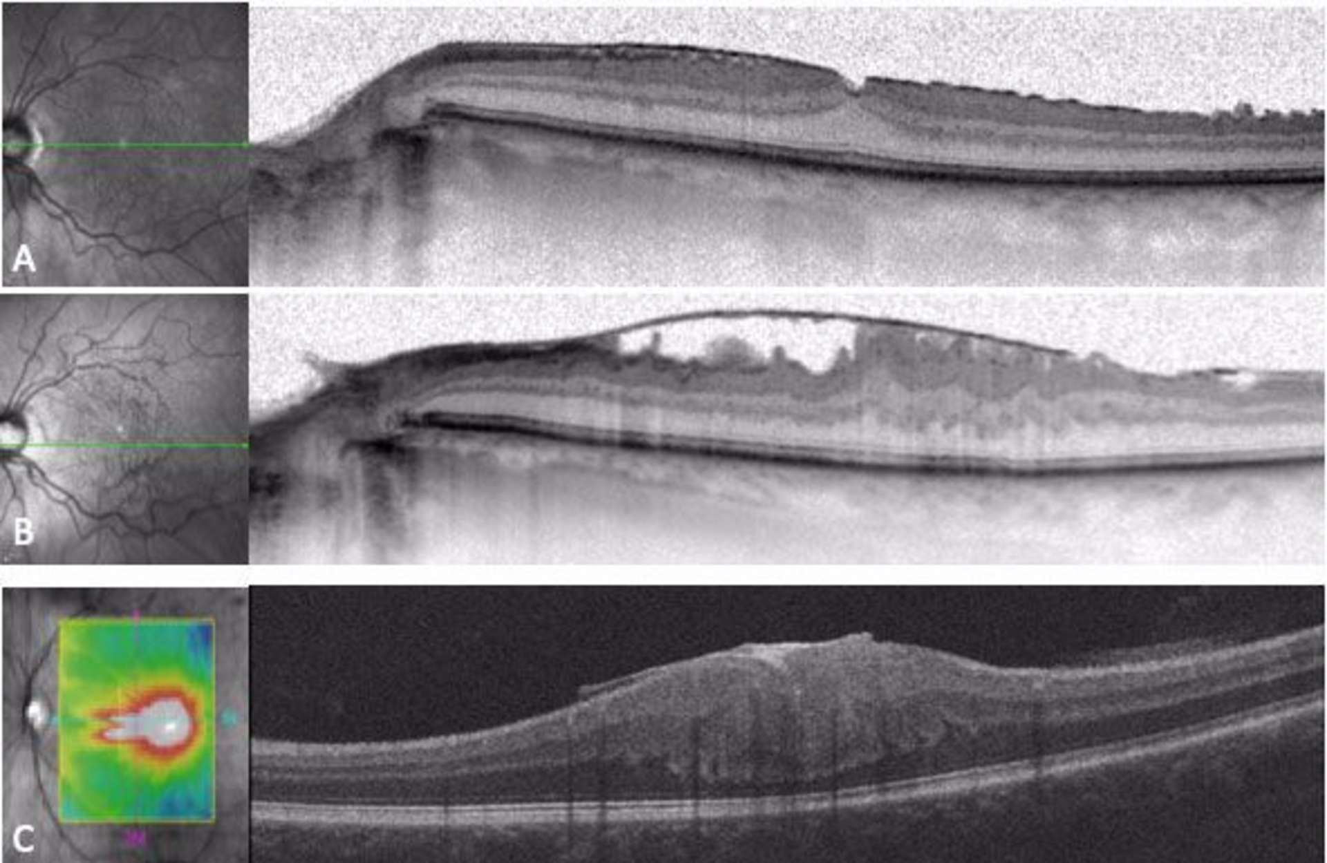 Figure 1. Coupes horizontales d’OCT B-scan de 3 cas de membranes épirétiniennes idiopathiques. A. MER avec un épaississement rétinien modéré et un profil fovéolaire relativement conservé. B. MER induisant un épaississement rétinien, une perte du profil fovéolaire et une contraction de la rétine mais sans ectopie : la couche nucléaire interne reste bien identifiable. C. MER associée à une ectopie des couches nucléaires internes, c’est-à-dire une désorganisation avec une couche nucléaire interne et une couche plexiforme interne non identifiables au centre.
