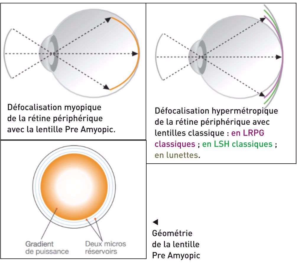 Lentilles rigides pour la prévention et la freination de la myopie cahiersophtalmologie