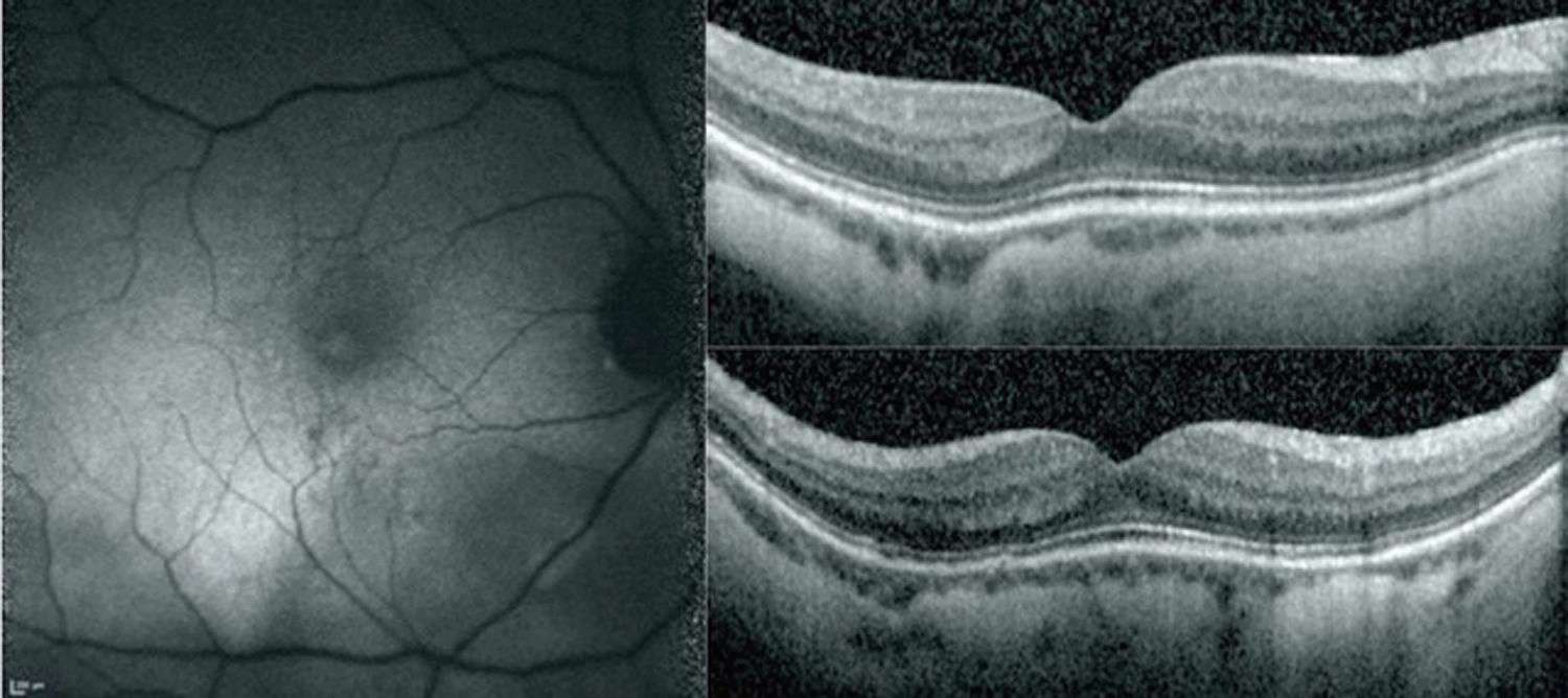 Figure 3. Examen en autofluorescence (à gauche) et OCT (à droite) d’une mini-MB chez un patient asymptomatique âgé de 74 ans. Un bombement de 25 µm est présent sur la coupe horizontale de l’OCT (en haut à droite) et de 41 µm sur la coupe verticale (en bas à droite), ce qui traduit un bombement arrondi en forme de dôme. On ne note pas de complication particulière (notamment pas de DSR ni d’atrophie de l’épithélium pigmentaire). Il existe une altération modérée de l’épithélium pigmentaire sur l’image en autofluorescence.
