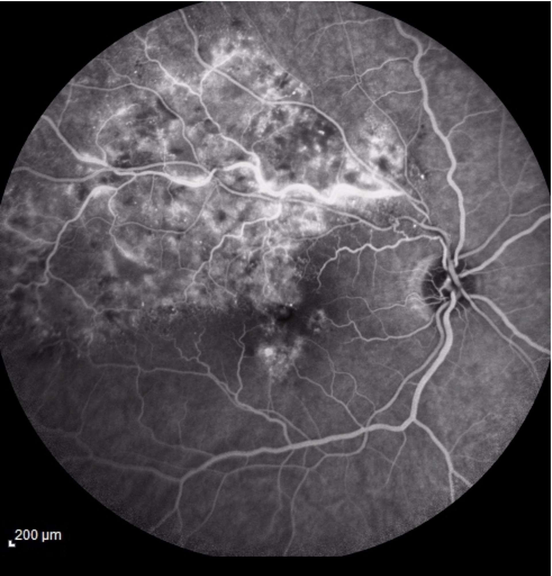 Patient 4. a. Angiofluorographie : tortuosité de la veine temporale supérieure avec croisement artérioveineux proximal marqué. Œdème « de stase » hyperfluorescent dans le même territoire et atteignant la macula.
