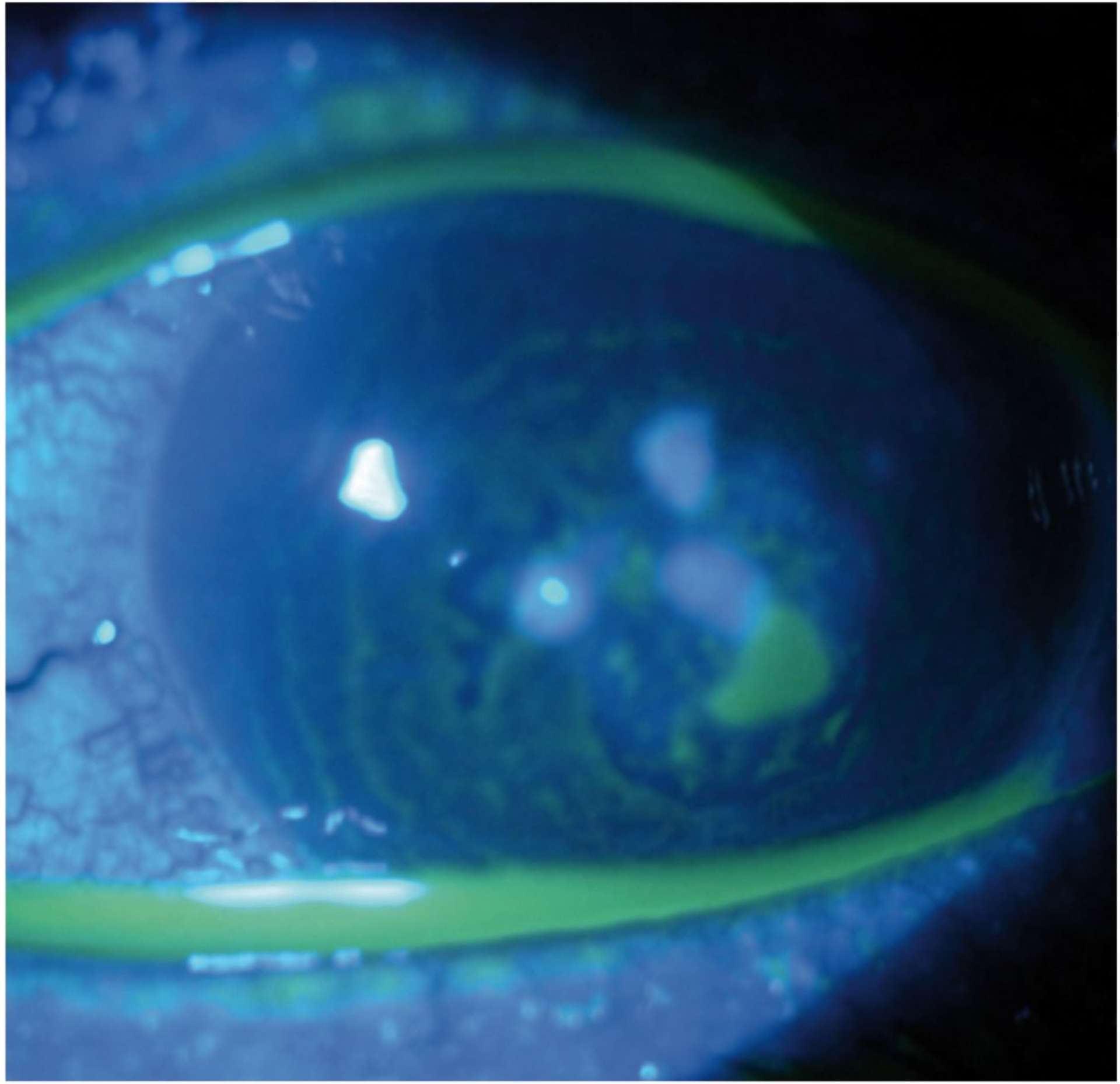 Figure 4B. Kératite fongique à Fusarium chez un menuisier après un trauma par corps étranger.
