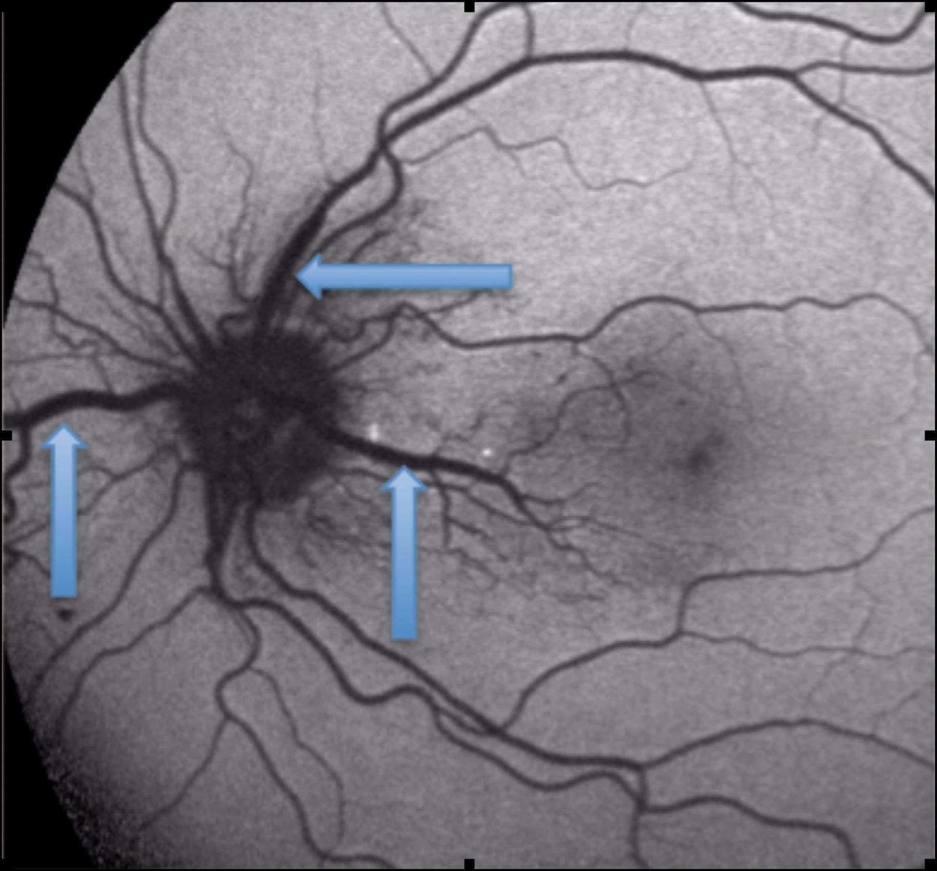 Figure 1. Cliché en autofluorescence du premier cas.
