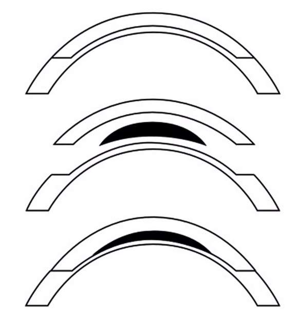Figure 2. Lenticule allogénique placé en inlay dans la cornée réceptrice.
