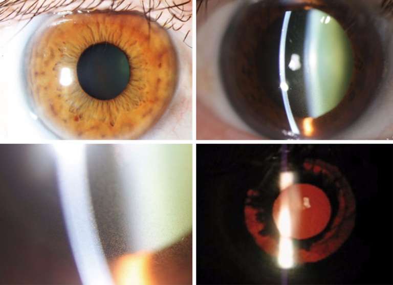 Figure 1. Alternance de zones pigmentées et de zones atrophiques (en haut à gauche). Libération de pigments après la dilatation pupillaire (en haut à droite). Tyndall pigmenté à fort grossissement (en bas à gauche). Plages transilluminables (en bas à droite).
