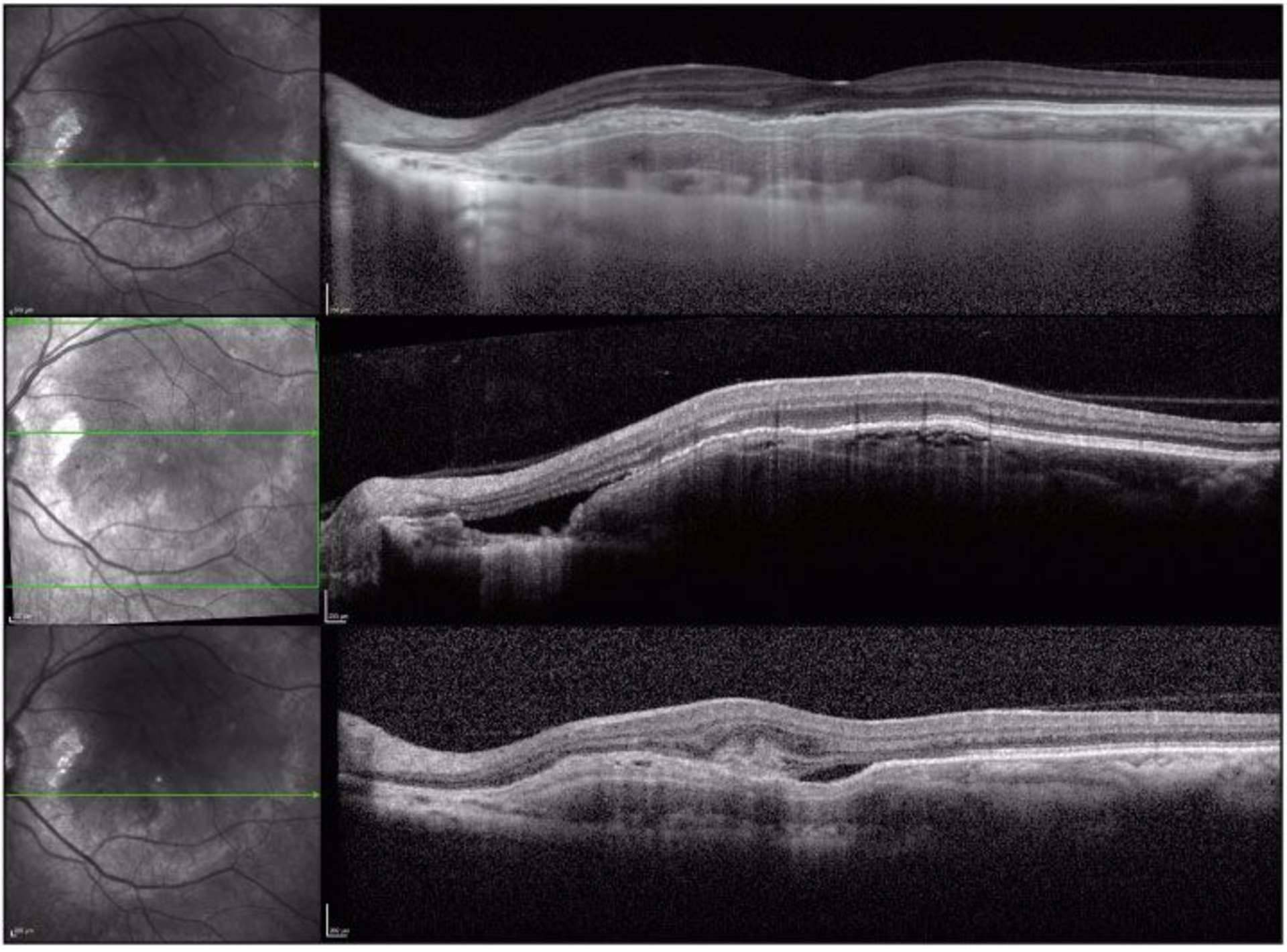 Figure 2. On note également une altération de la rétine externe en regard, un décollement séreux rétinien avec une zone de gris préépithélial en regard suggérant la présence d’un néovaisseau choroïdien. 
