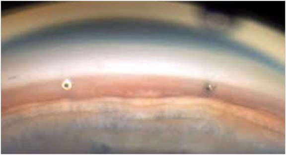 Figure 2. Vue gonioscopique après l’insertion dans le quadrant nasal inférieur de 2 drains iStent inject.&nbsp;
