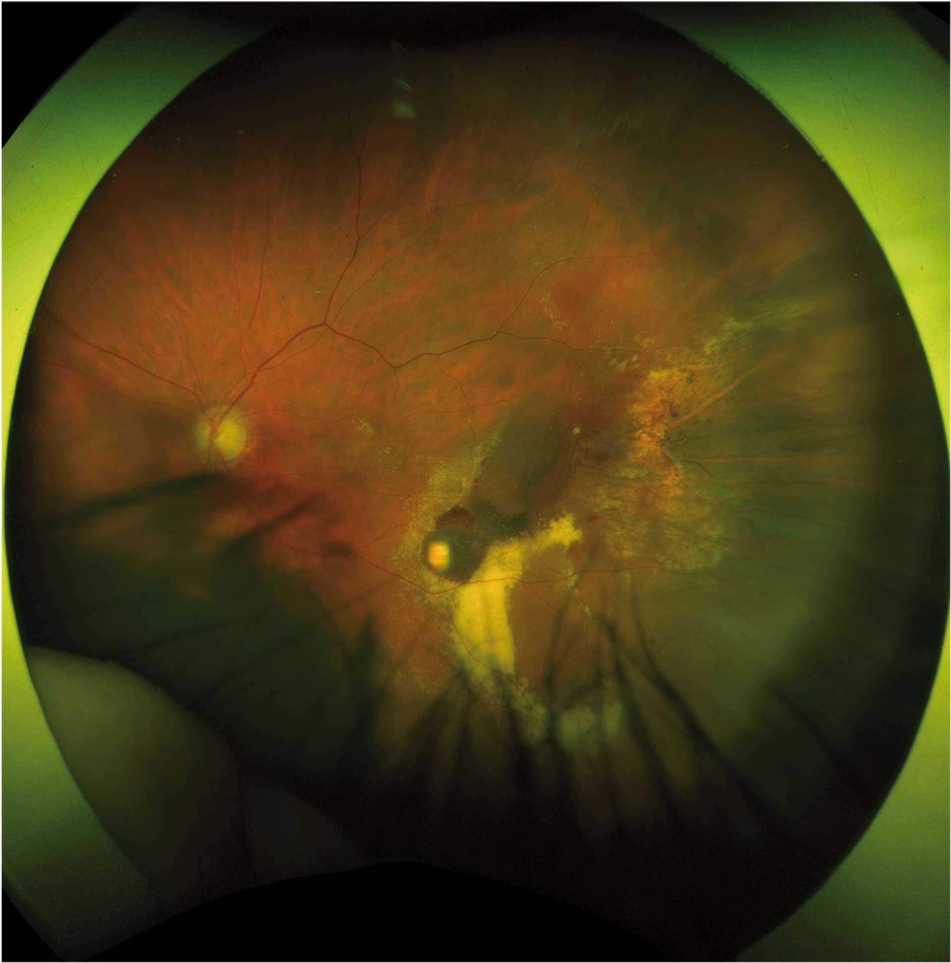 Figure 1. Photographie couleur en ultra grand champ du fond d’œil gauche retrouvant une volumineuse plage hémorragique en périphérie inférotemporale accompagnée d’exsudats lipidiques, de liquide sous-rétinien et d’une plage d’atrophie périphérique.
