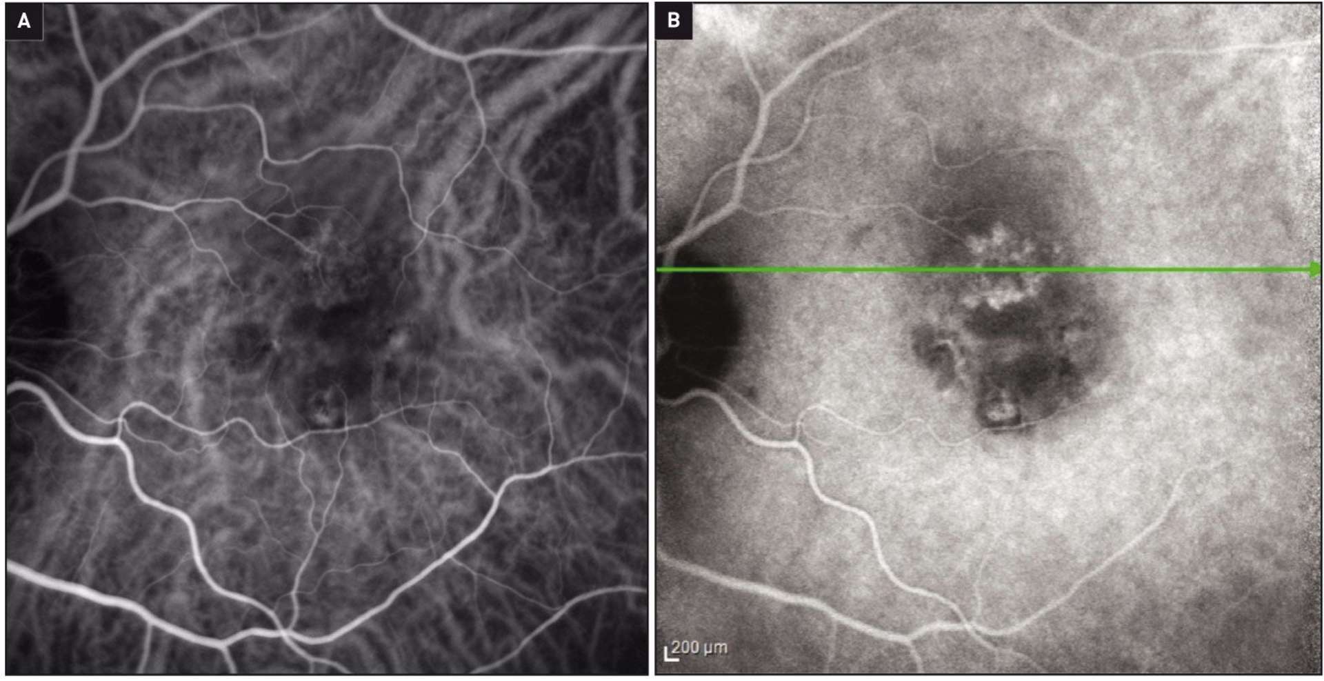 Figure 2. Angiographie au vert d'indocyanine aux temps précoce (A) et tardif (B).
