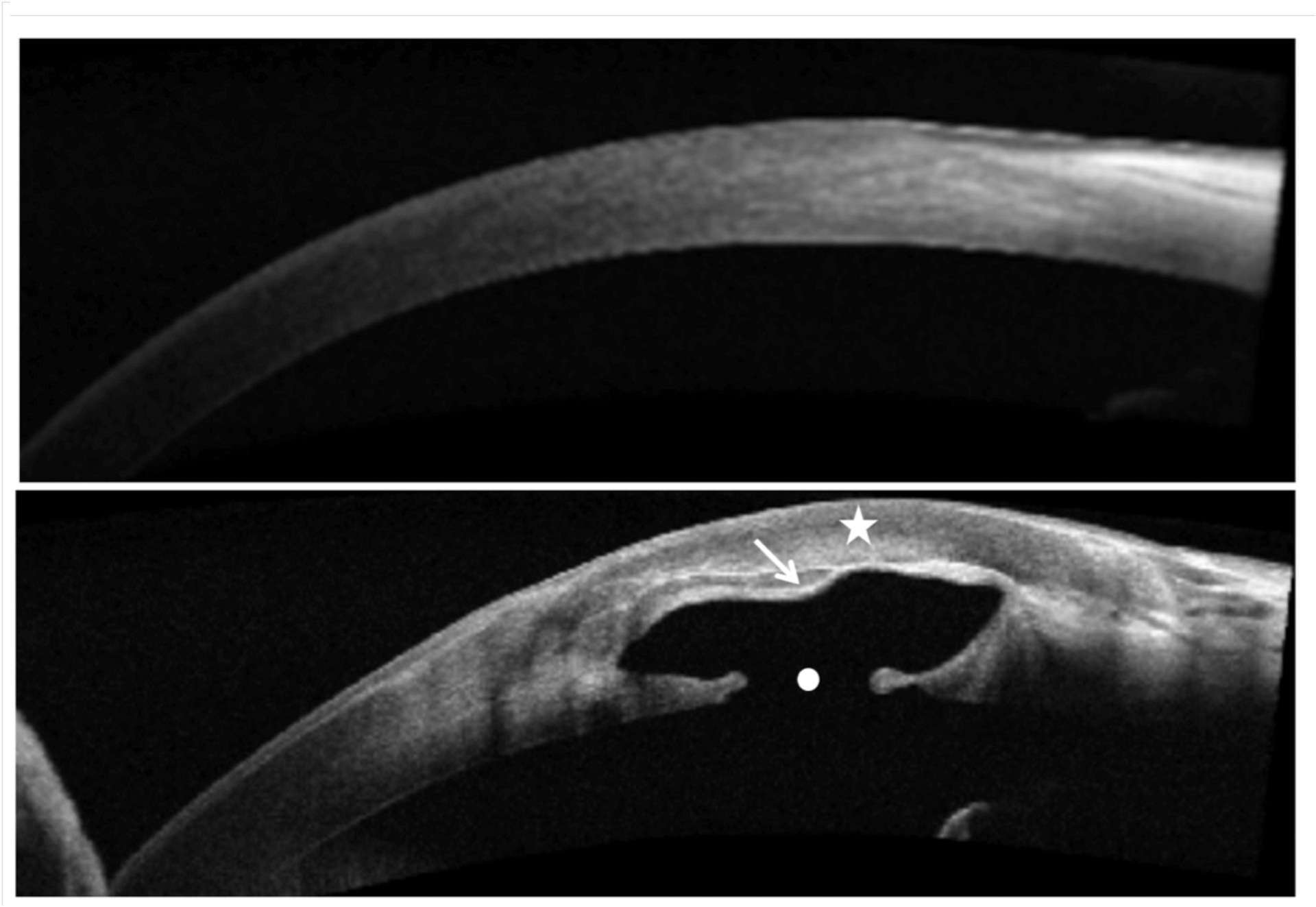 Figure 4. Coupe postopératoire en OCT HR, verticale et centrée sur le limbe (Cirrus 5000-Zeiss). Œil gauche en haut, œil droit en bas, montrant le greffon lamellaire (étoile) coiffant la zone d’amincis­sement (flèche) et la brèche endothéliale sous-jacente (point).
