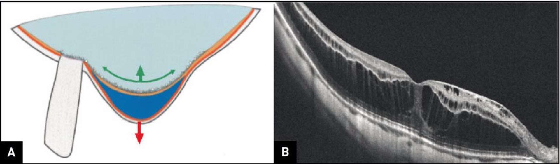 Figure 1. Schéma des forces expliquant l’apparition du FS du myope fort et diagnostic en OCT. A. Rigidification et traction antérieure de la surface de la rétine (flèche verte), attraction postérieure de la rétine externe (flèche rouge). B. L’épaississement rétinien et une hyporéflectivité des couches externes des éléments hyperréflectifs au niveau de l’épithélium pigmenté et les travées correspondant à l’étirement des cellules de Muller sont caractéristiques en OCT.

