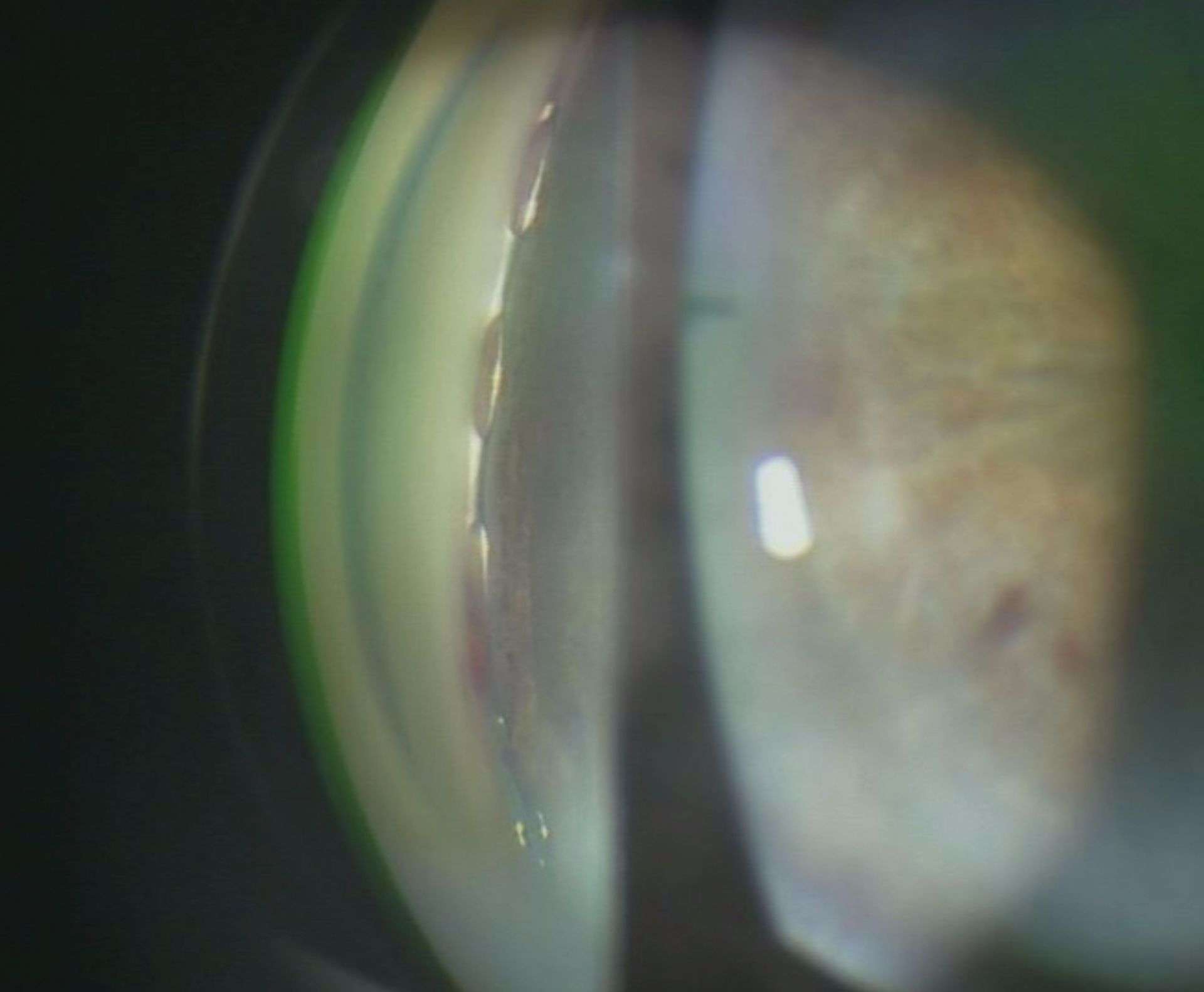 Figure 1. B. Drain ab interno (Hydrus, Ivantis, États-Unis) inséré dans le secteur nasal du canal de Schlemm.
