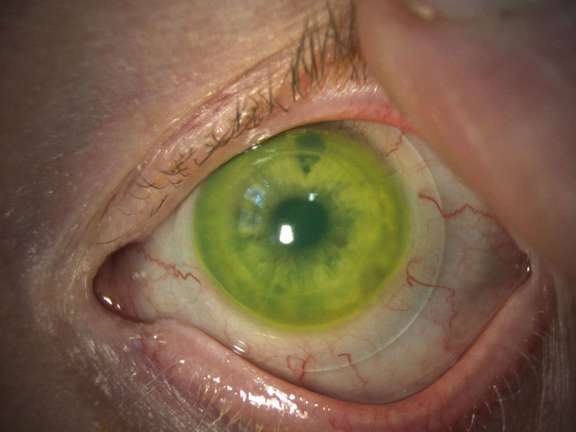 Figure 1. Lentille sclérale (Time XL diamètre 16,50 mm, Menicon) chez un patient avec une greffe de cornée de l’œil gauche pour un kératocône. Son acuité visuelle est passée de 3/10 en lunettes à 10/10 avec la lentille.&nbsp;
