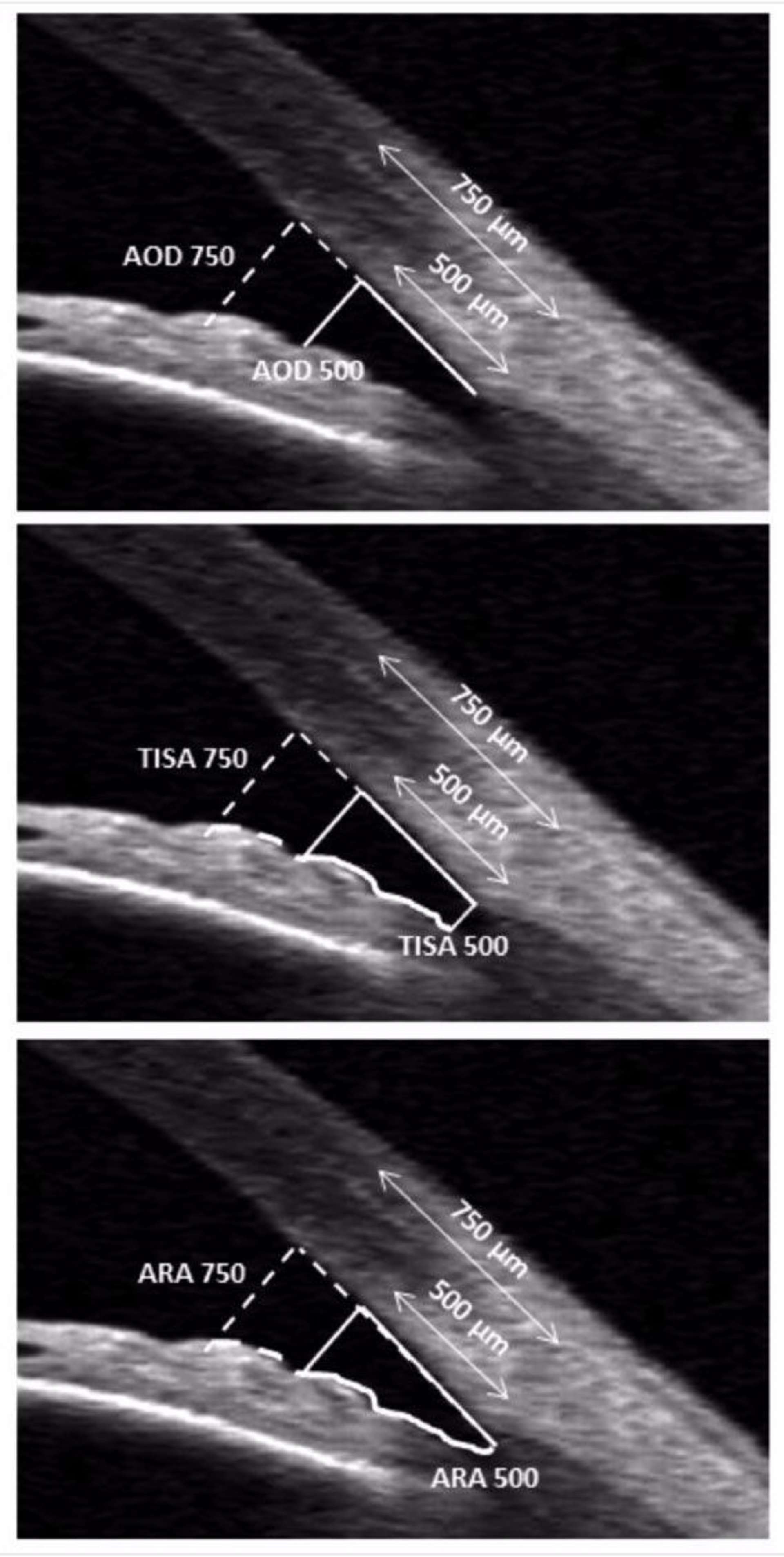 Figure 2. Coupes du segment antérieur en tomographie par cohérence optique, avec différents paramètres biométriques caractérisant l’ouverture de l’angle iridocornéen. AOD : Angle Opening Distance à 500 µm et 750 µm de l’éperon scléral. TISA : Trabecular-Iris Space à 500 µm et 750 µm de l’éperon scléral. ARA : Angle Recess Area à 500 µm et 750 µm de l’éperon scléral.
