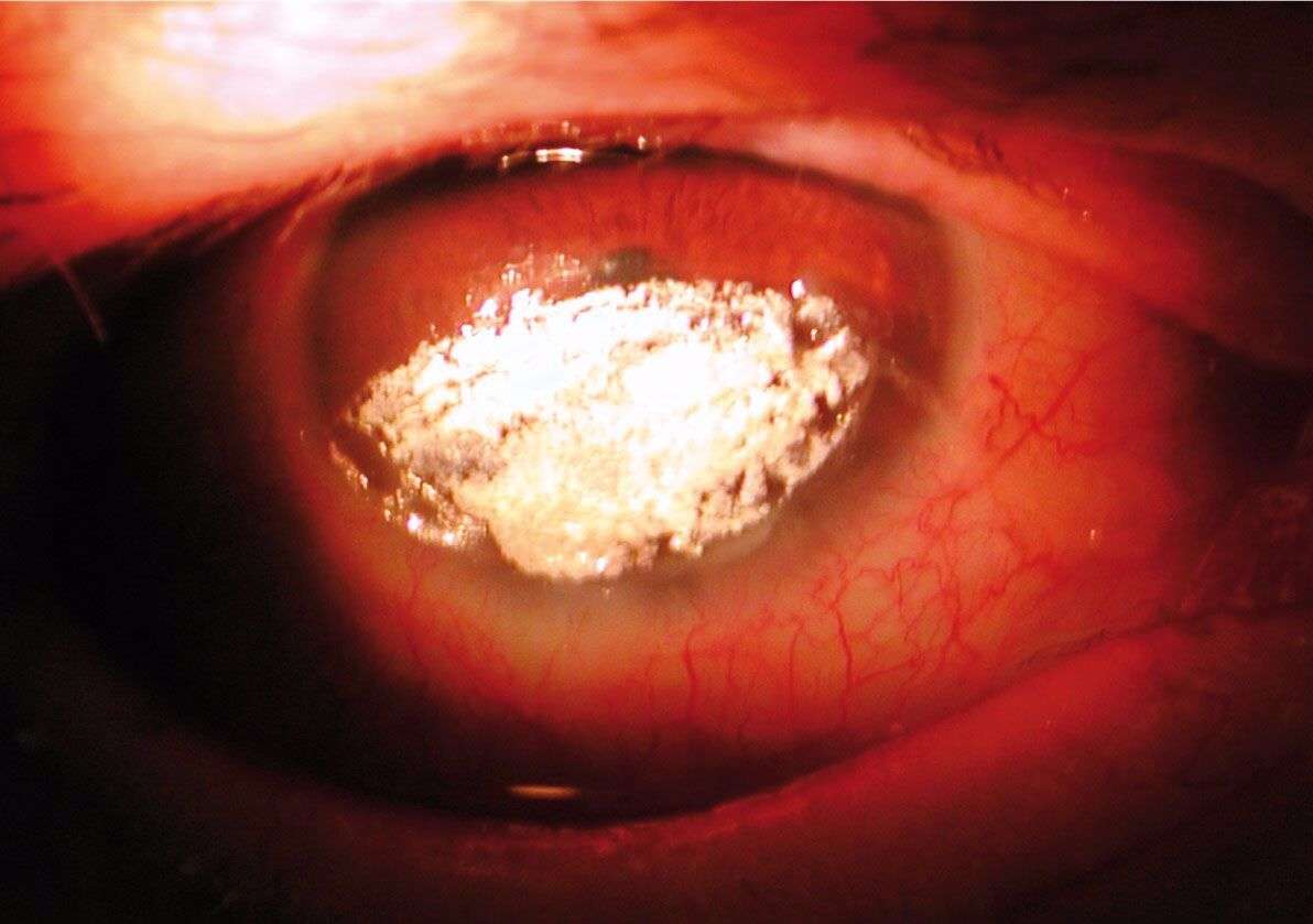 Figure 1. Dépôts de ciprofloxacine.
