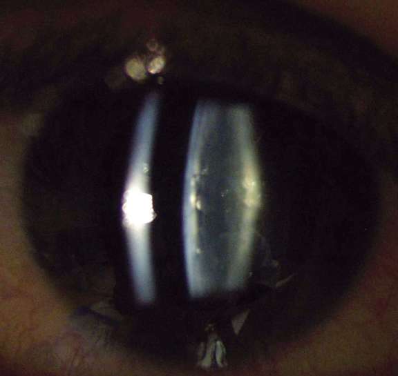 Figure 1. Cataracte corticale antérieure et postérieure en coupe.
