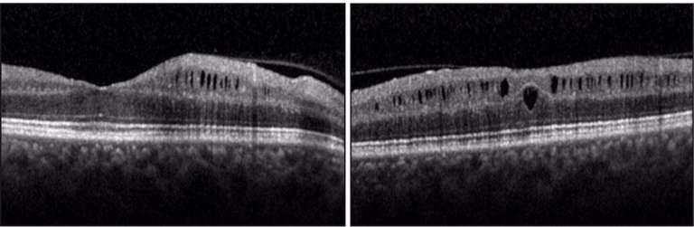 Un tableau atypique de drusen papillaires : un train peut en cacher un autre - cahiers-ophtalmologie