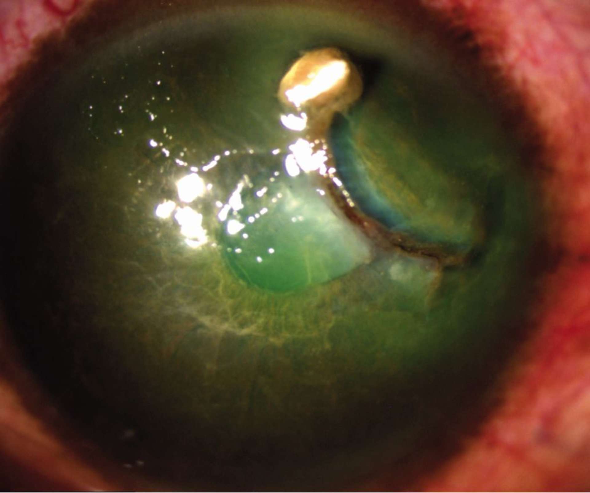 Figure 1. Photo à la lampe à fente de plaie du globe ouverte avec corps étranger en plastique par porte d’entrée cornéenne et induction de cataracte traumatique.
