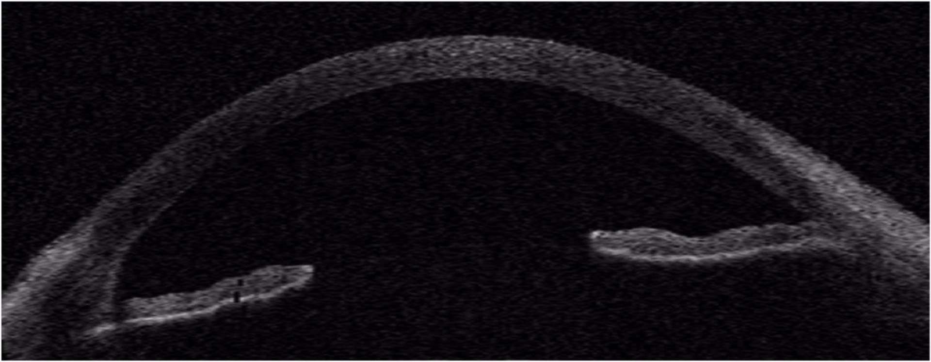 Figure 7. Récession angulaire (partie gauche de l’image, recul de l’iris) et angle iridocornéen normal à droite de la coupe.
