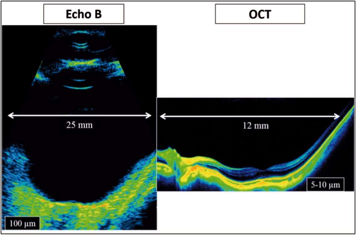 Comparaison entre une image obtenue par écho B (Aviso, sonde de 10 MHz, Quantel Médical) et par OCT SD (RTVue, Optovue) montrant une meilleure résolution pour l’OCT mais une fenêtre d’examen nettement plus large pour l’écho B.
