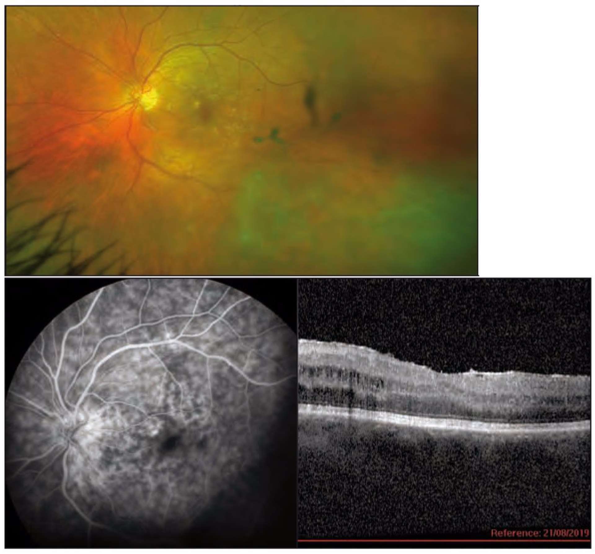 Figure 4. Œdème maculaire et œdème papillaire chronique chez un patient avec une uvéite intermédiaire sur toxocarose. Le fond œil retrouve des condensations vitréennes, l’angiographie à la fluroescéine une capillaropathie diffuse, une maculopathie œdèmateuse et une papillite. L’OCT retrouve un œdème maculaire avec un épaississement rétinien et des logettes intrarétiniennes.
