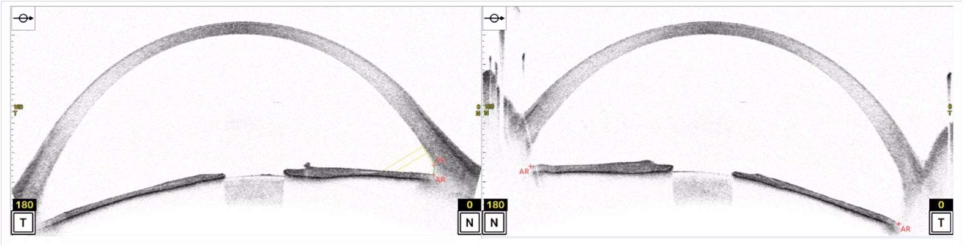 Figure 2. OCT du segment antérieur de l’œil droit (photo de gauche) et de l’œil gauche (photo de droite) montrant une protrusion globale cornéenne.
