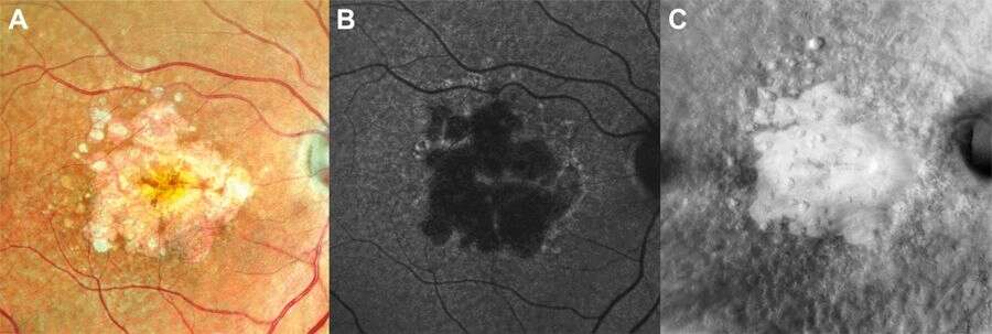 Figure 2. A. Image en couleur du fond d’œil montrant l’atrophie géographique. B. Image en autofluorescence montrant l’hypo-autofluorescence maculaire correspondant à l’atrophie de l’épithélium pigmentaire. Noter la zone iso-autofluorescente centrale indiquant la présence d’un ilot fovéolaire persistant. C. Image RétroMode montrant une zone lisse et déprimée correspondant à l’atrophie géographique. Les drusen environnants apparaissent sous la forme de mottes surélevées.
