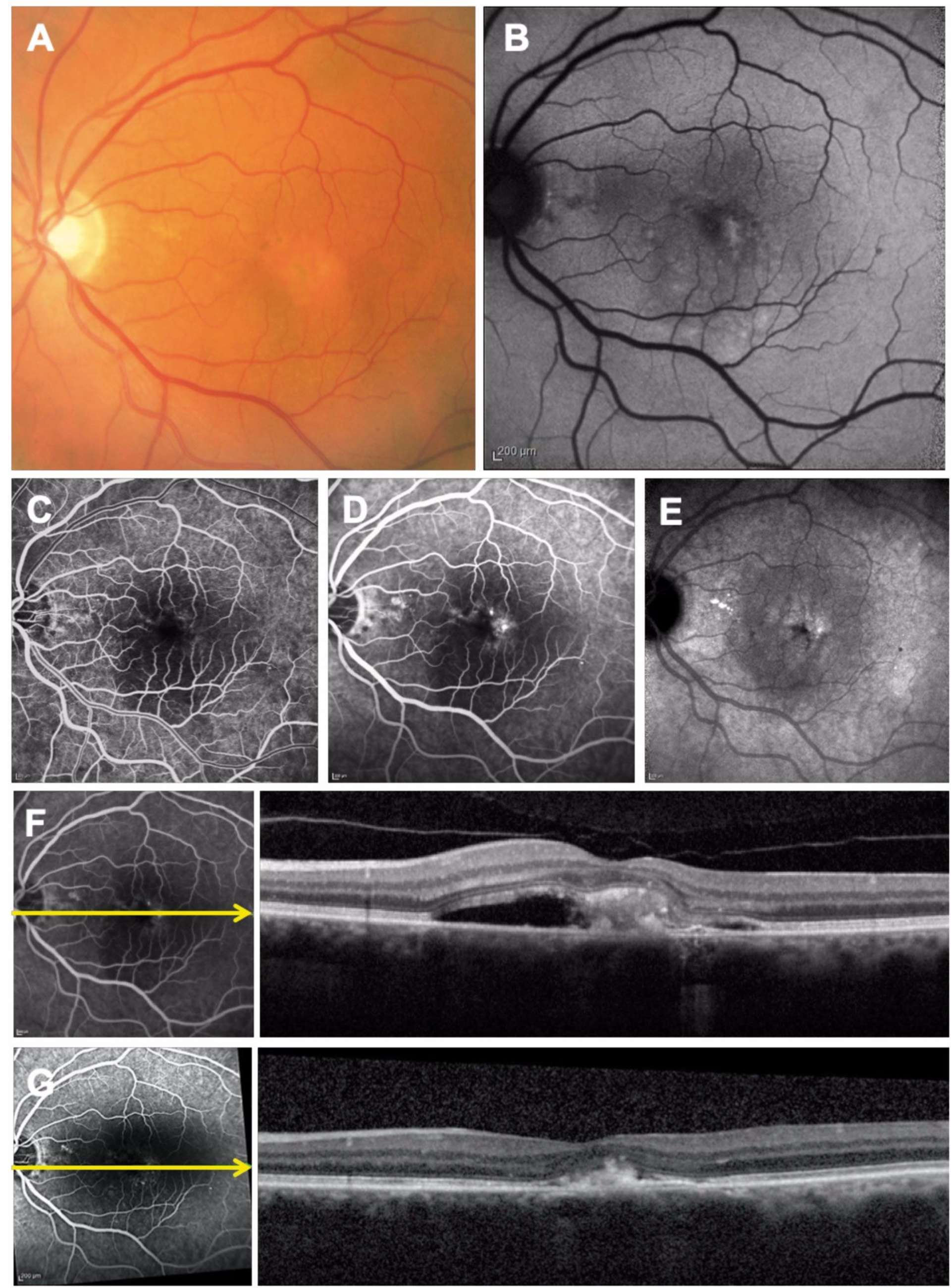 Figure 4. Les clichés couleur (A) et en autofluorescence (B) confirment la présence d’un dépôt jaunâtre hyper-autofluorescent fovéolaire. L’angiographie à la fluorescéine (C et D) montre une hyperfluorescence temporo-fovéolaire qui diffuse. En ICG (E), on note une hyperfluorescence tardive en temporo-fovéolaire. L’OCT-SD (F) montre une hyperréflectivité sous-rétinienne associée à un DSR. Après traitement par IVT d’anti-VEGF, l’OCT affiche une résorption complète du DSR (G). Il persiste le dépôt de matériel hyper-réflectif, rétrofovéolaire.
