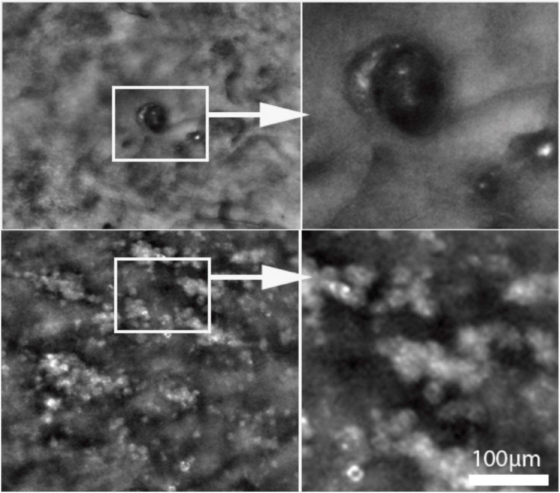 Figure 4. Exemple de microanévrysme (rangée du haut) et d’exsudats durs imagés par OOA. Noter la visibilité du mur du microanévrysme.
