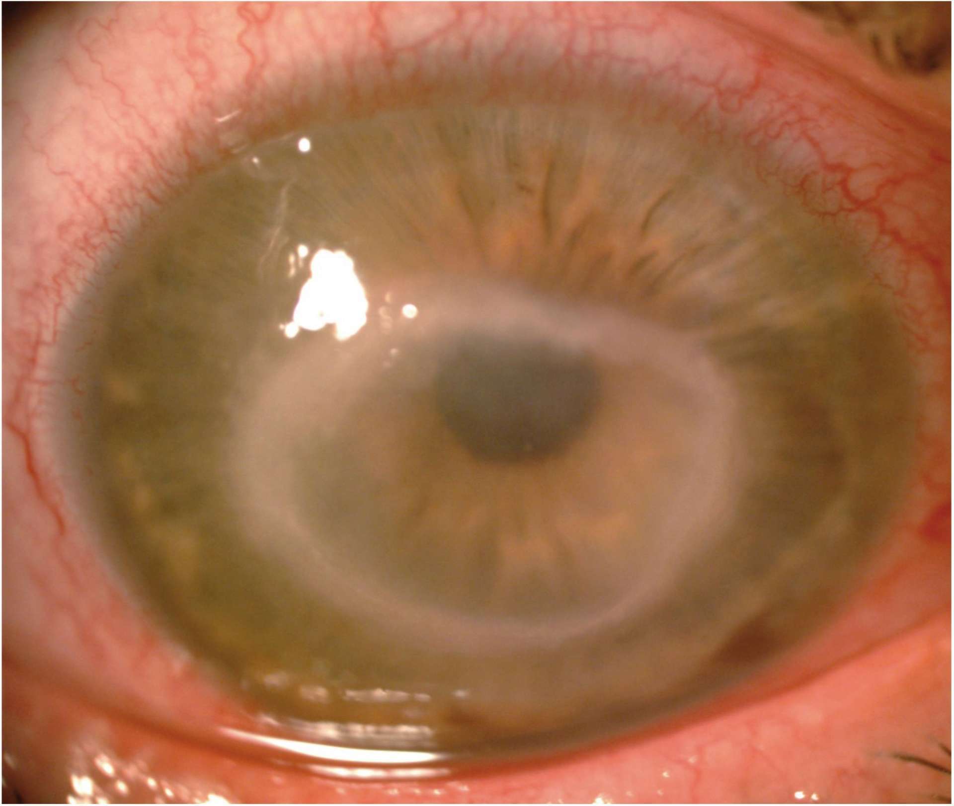 Figure 3. Kératite amibienne avec un anneau immunitaire chez une patiente porteuse de lentilles de contact souples hydrophiles à la piscine.
